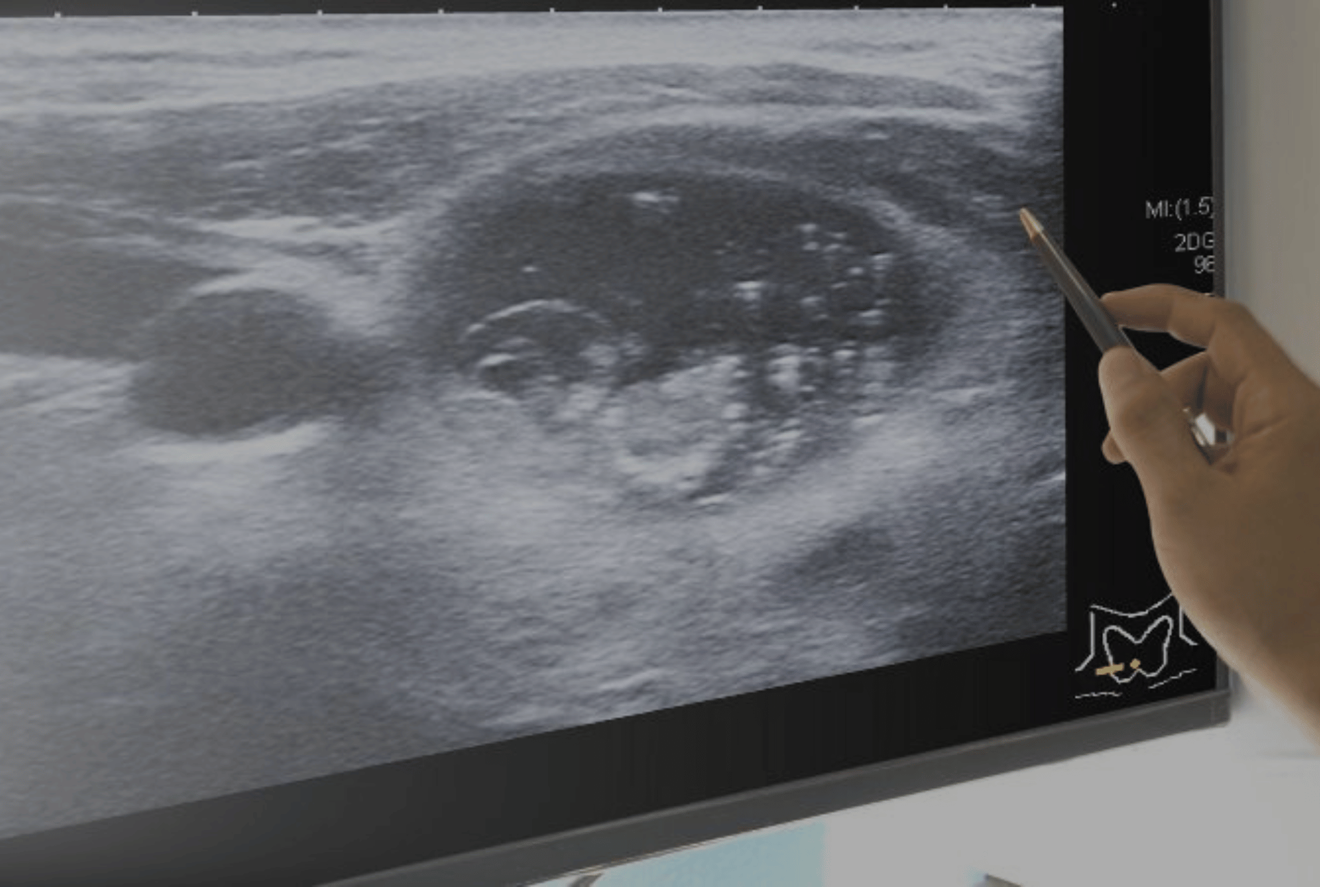 Thyroid detection on ultrasound images with AI